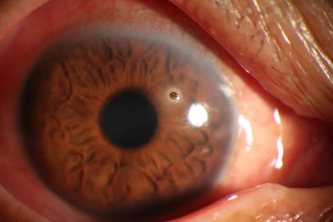 眼前节照相怎么照常见眼前段疾病一览_https://www.jmylbn.com_新闻资讯_第13张