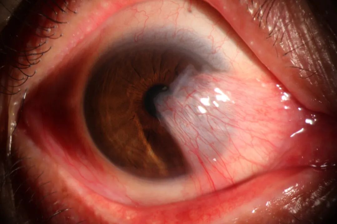 眼前节照相怎么照常见眼前段疾病一览_https://www.jmylbn.com_新闻资讯_第10张