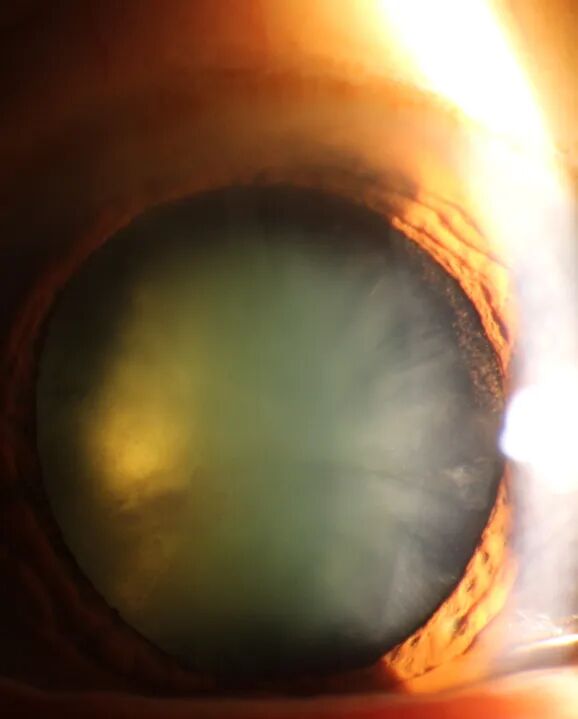 眼前节照相怎么照常见眼前段疾病一览_https://www.jmylbn.com_新闻资讯_第11张