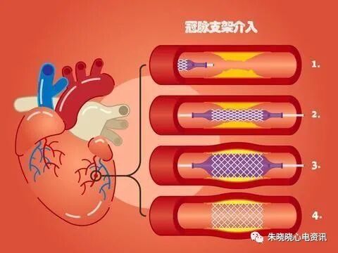 从菜鸟到高手：冠心病介入治疗实战技巧分享