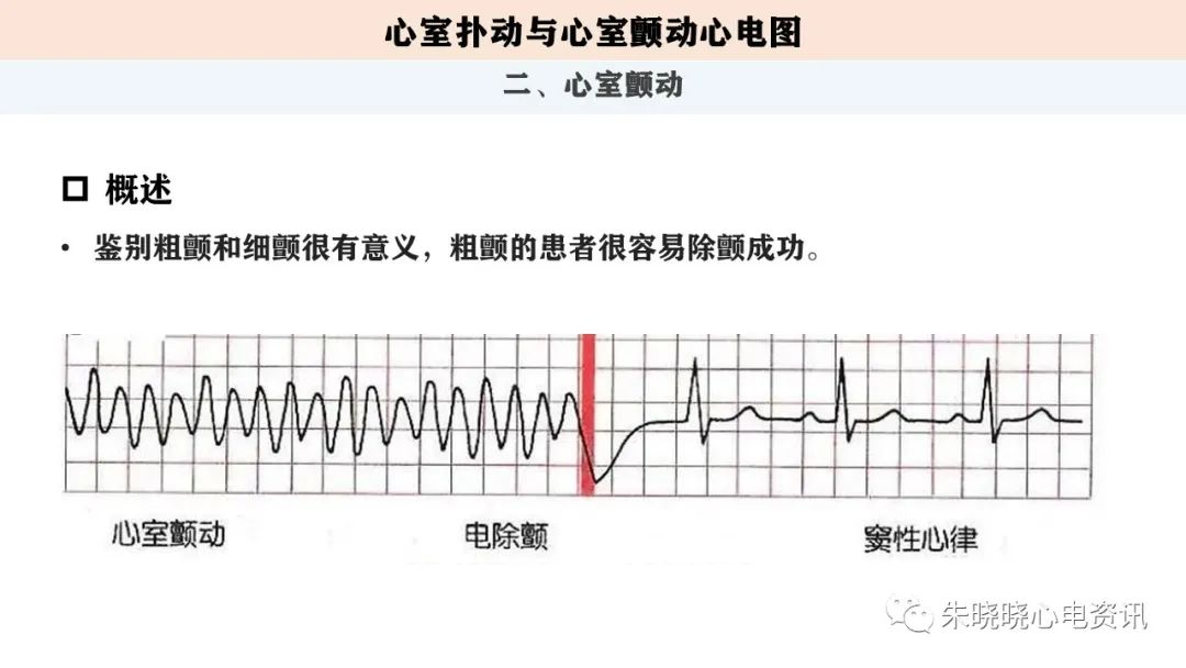心电图解读：室扑与室颤心电图（ppt）