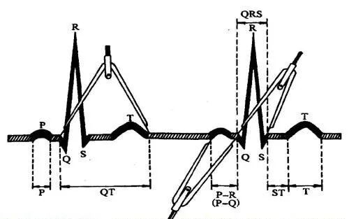 心电图纸怎么看【临床实用心电图入门】第三讲：心电图的测量要点_https://www.jmylbn.com_新闻资讯_第5张