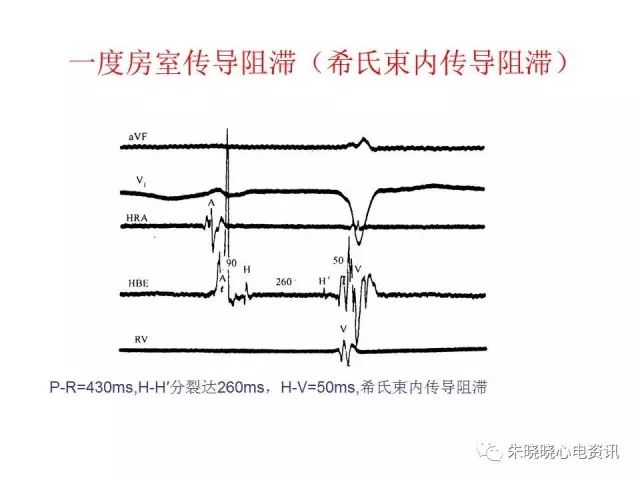 如何确定房室传导阻滞的部位(ppt)-卢喜烈老师