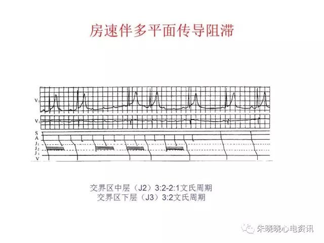 如何确定房室传导阻滞的部位(ppt)-卢喜烈老师