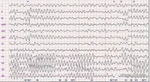 心电监护怎么看图【PLUS版】心电图危急值识别及紧急处理，值得每个医生收藏！！！_https://www.jmylbn.com_新闻资讯_第27张