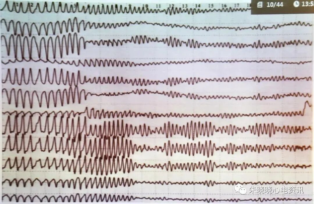心电监护怎么看图【PLUS版】心电图危急值识别及紧急处理，值得每个医生收藏！！！_https://www.jmylbn.com_新闻资讯_第28张