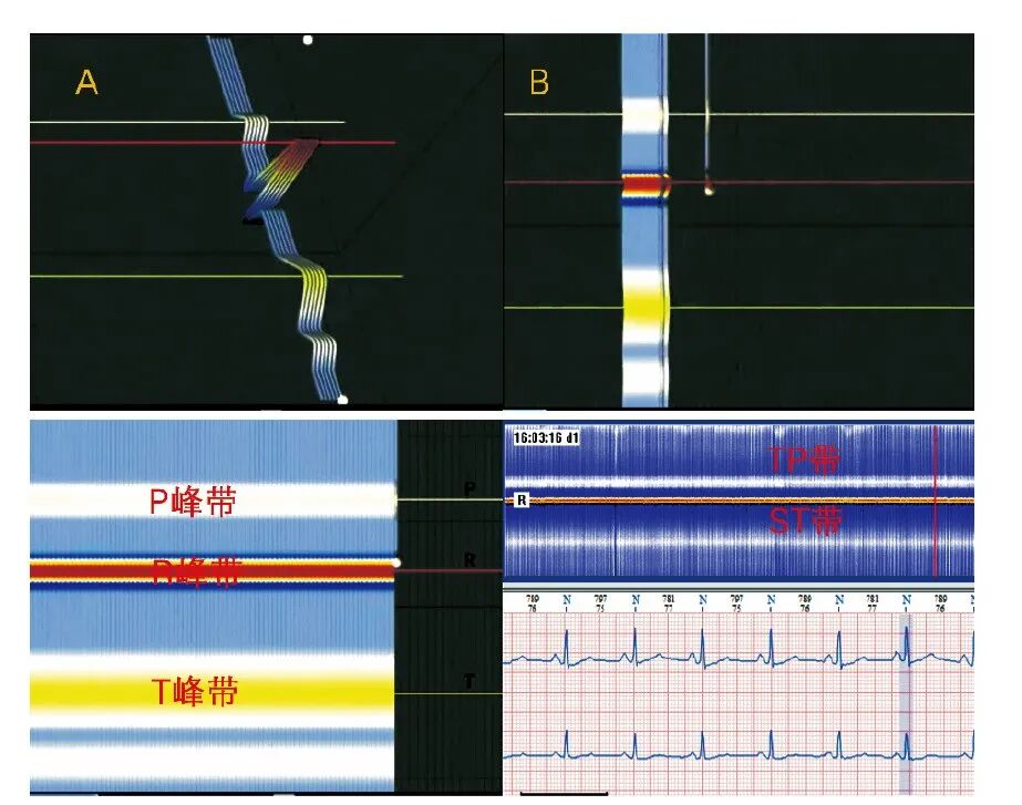 动态心电图怎么分析各种分析工具在动态心电图分析中的应用_https://www.jmylbn.com_新闻资讯_第6张