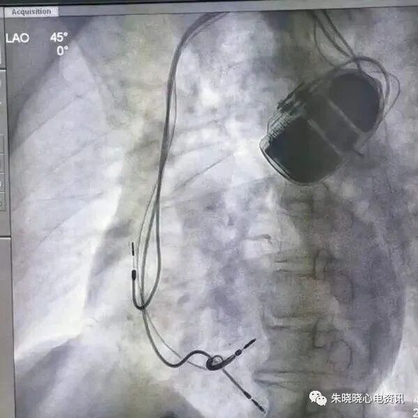 百多力起搏器怎么样“贴心”的通过胸片识别起搏器方法，让你秒懂_https://www.jmylbn.com_新闻资讯_第19张