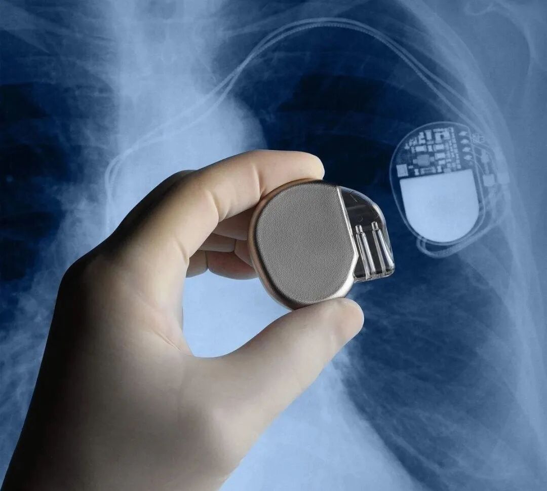 百多力起搏器怎么样通过胸片识别起搏器的简易三步法_https://www.jmylbn.com_新闻资讯_第3张