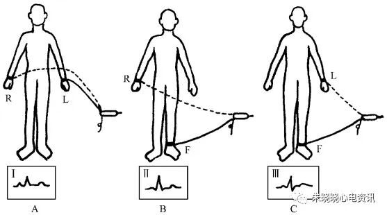 心电图怎么切换导联23种肢体导联错接心电图特点_https://www.jmylbn.com_新闻资讯_第25张