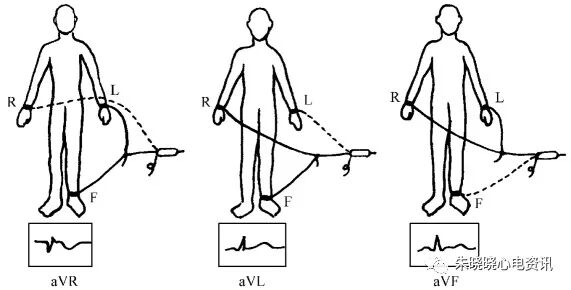 心电图怎么切换导联23种肢体导联错接心电图特点_https://www.jmylbn.com_新闻资讯_第26张