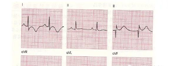 为什么选择双相波【临床实用心电图入门】 第十二讲：T波改变与心肌缺血_https://www.jmylbn.com_新闻资讯_第6张