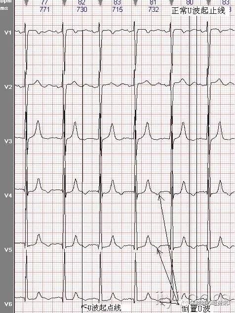 为什么选择双相波【临床实用心电图入门】 第十二讲：T波改变与心肌缺血_https://www.jmylbn.com_新闻资讯_第11张