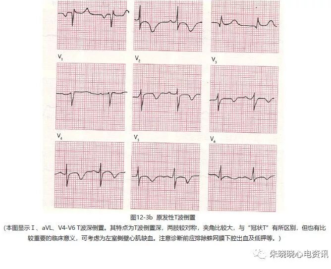 为什么选择双相波【临床实用心电图入门】 第十二讲：T波改变与心肌缺血_https://www.jmylbn.com_新闻资讯_第7张