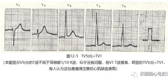 为什么选择双相波【临床实用心电图入门】 第十二讲：T波改变与心肌缺血_https://www.jmylbn.com_新闻资讯_第10张