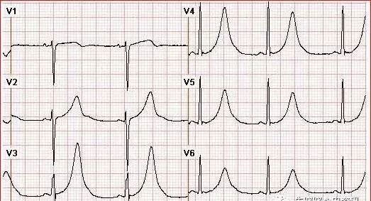 为什么选择双相波【临床实用心电图入门】 第十二讲：T波改变与心肌缺血_https://www.jmylbn.com_新闻资讯_第9张