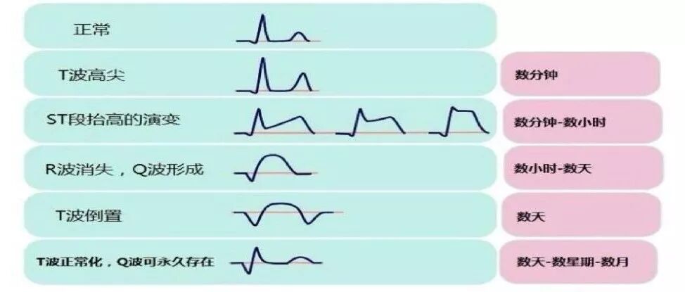 为什么选择双相波【临床实用心电图入门】 第十二讲：T波改变与心肌缺血_https://www.jmylbn.com_新闻资讯_第2张