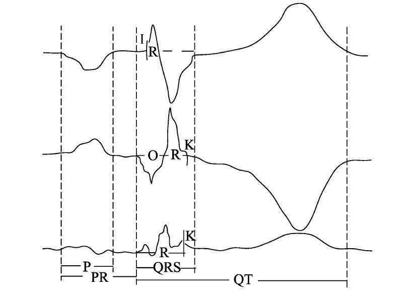 什么是同步心电图心电图测量技术指南_https://www.jmylbn.com_新闻资讯_第9张