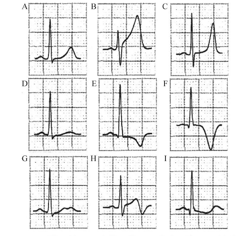什么是同步心电图心电图测量技术指南_https://www.jmylbn.com_新闻资讯_第8张