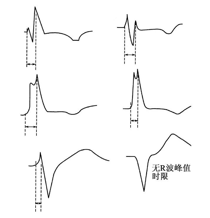 什么是同步心电图心电图测量技术指南_https://www.jmylbn.com_新闻资讯_第10张