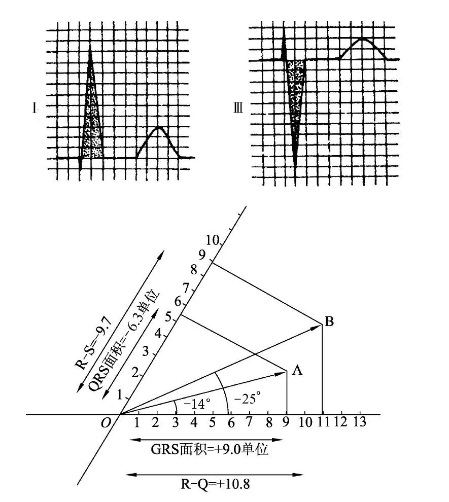 什么是同步心电图心电图测量技术指南_https://www.jmylbn.com_新闻资讯_第14张