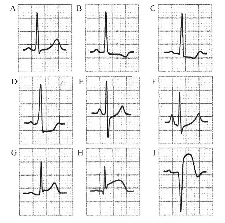 什么是同步心电图心电图测量技术指南_https://www.jmylbn.com_新闻资讯_第7张