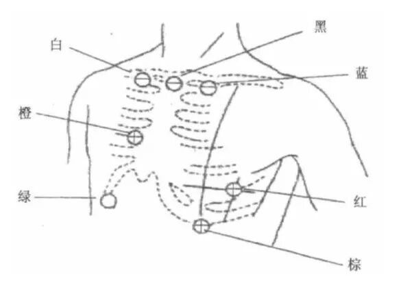 holter电极怎么贴动态心电图的规范化_https://www.jmylbn.com_新闻资讯_第10张