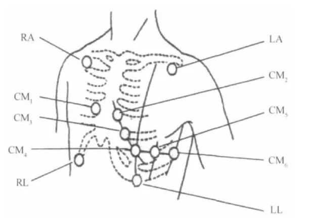 holter电极怎么贴动态心电图的规范化_https://www.jmylbn.com_新闻资讯_第11张