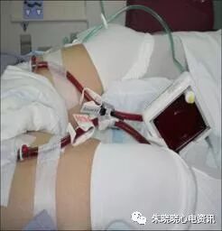 什么是气体陷闭ECMO的裝置与准备_https://www.jmylbn.com_新闻资讯_第15张