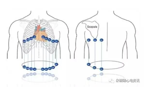 心电图怎么切换导联临床实用心电图入门系列之二：心电图导联、波形及临床价值_https://www.jmylbn.com_新闻资讯_第12张