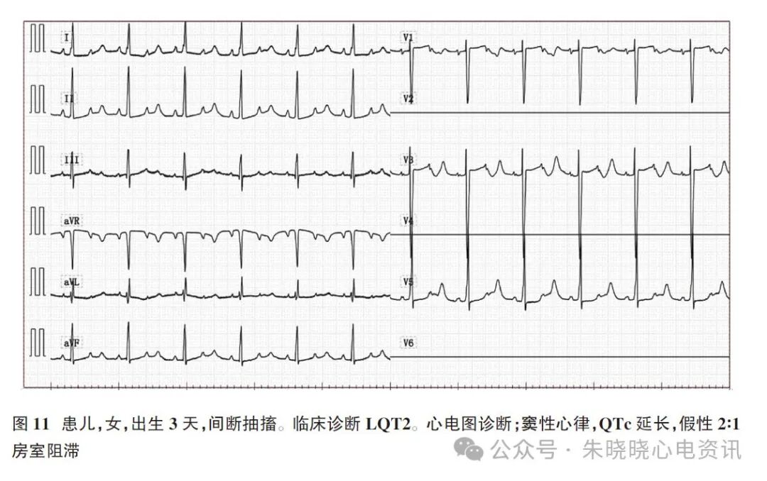 胎儿心电图是什么意思新生儿心电图精要_https://www.jmylbn.com_新闻资讯_第14张