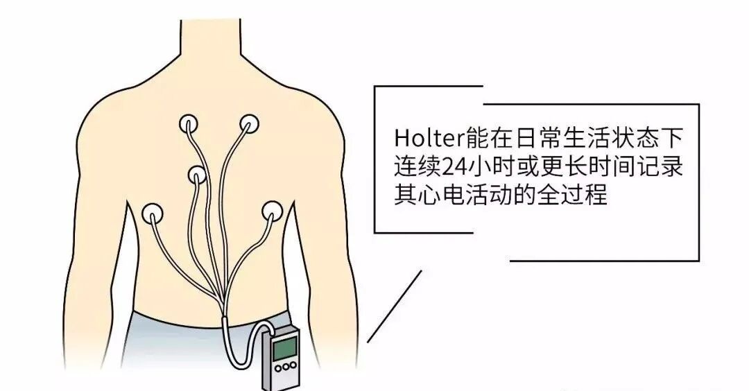 动态心电图怎么分析各种分析工具在动态心电图分析中的应用_https://www.jmylbn.com_新闻资讯_第3张