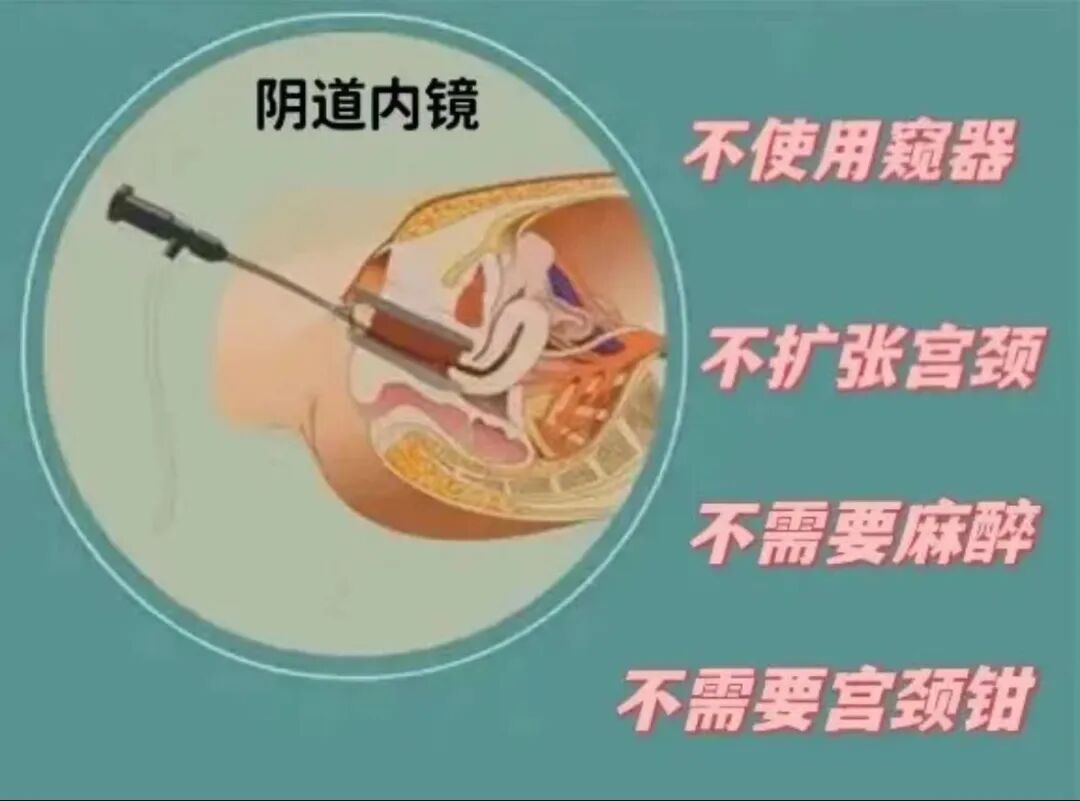 宫内镜怎么进入子宫我院妇科成功开展阴道内镜检查+经阴道内镜子宫内膜息肉切除术_https://www.jmylbn.com_新闻资讯_第4张