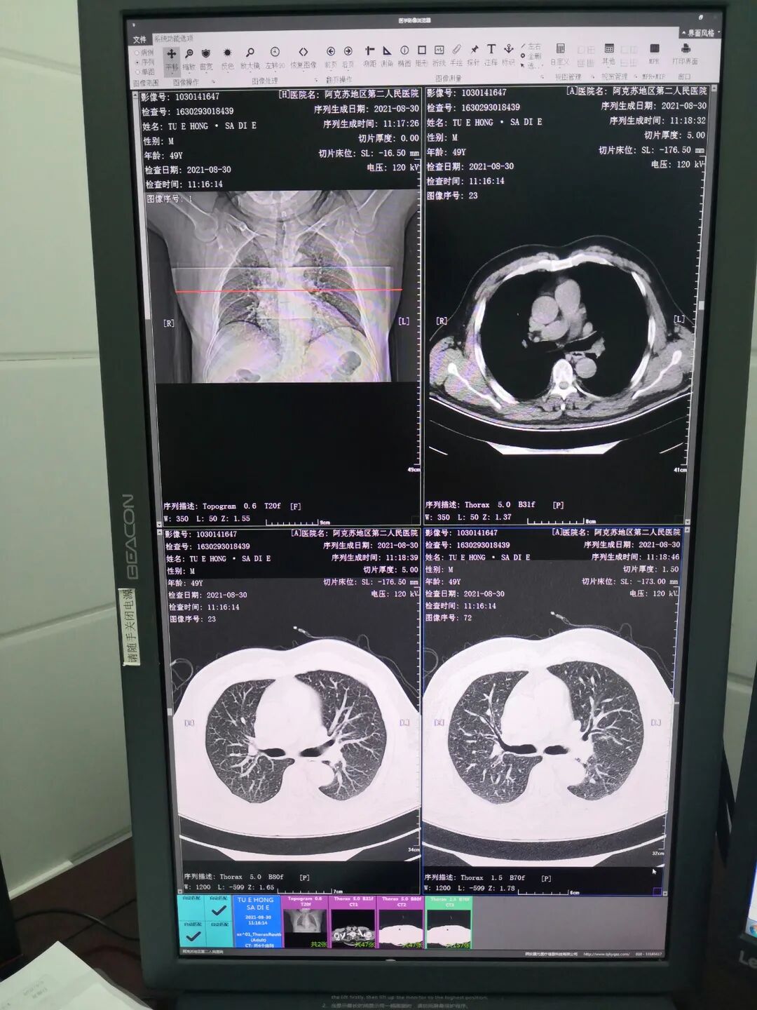拍胃肠机怎么收费拍一次CT辐射有多大？会致癌吗？走进放射科一起了解_https://www.jmylbn.com_新闻资讯_第7张