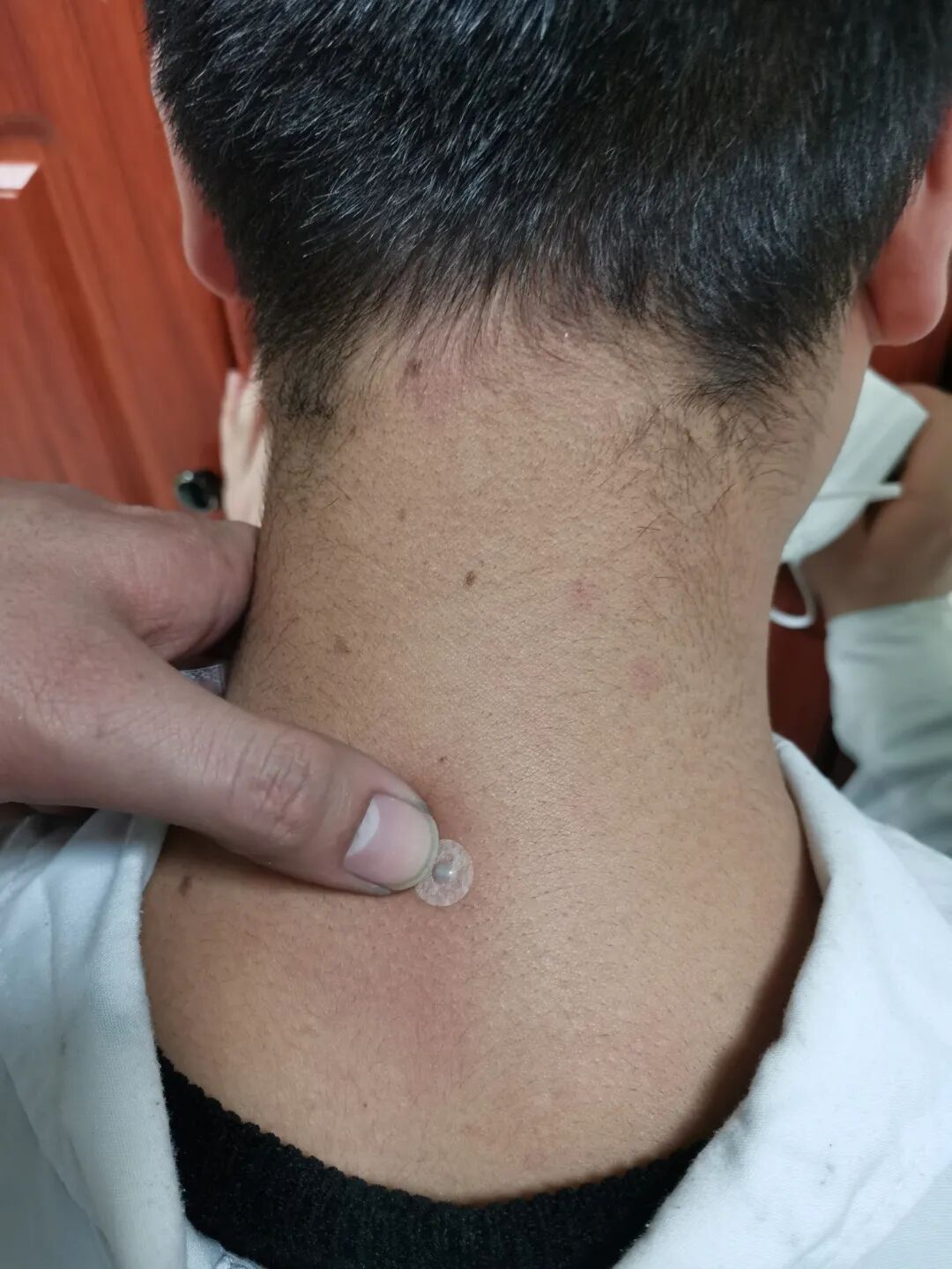 嵌针是什么【中医特色疗法】埋针，一种无痛的针刺疗法-上海聚慕医疗器械有限公司