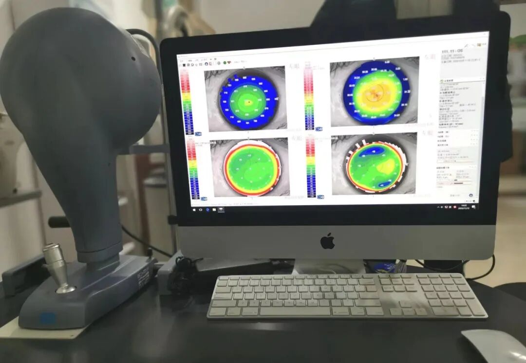 眼科有哪些设备眼科医生的好帮手——眼科检查设备有哪些_https://www.jmylbn.com_新闻资讯_第27张