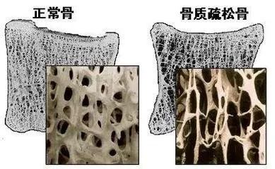 这些关于骨质疏松的错误认识，您都知道吗？