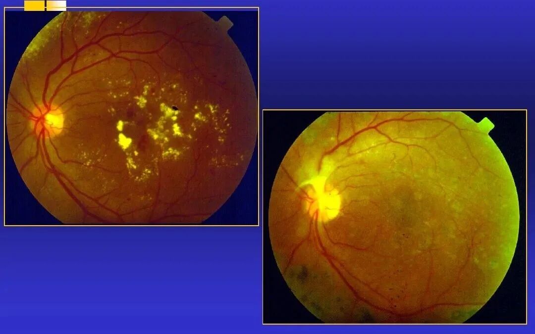 眼底激光机有什么牌子【告别雾里看花】​法国光太眼底激光仪落户宁远爱尔眼科医院！！_https://www.jmylbn.com_新闻资讯_第22张