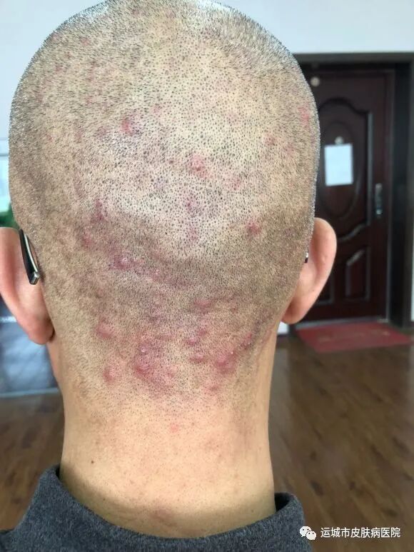 毛囊炎变成硬疙瘩不消