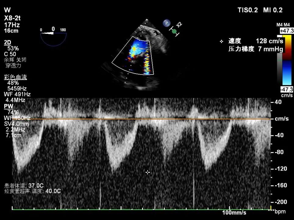 导丝怎么扩挑战高龄高危极限，引领微创“心”突破！大医二院赵昕教授团队使用Renatus®球扩瓣成功完成一例高难度经导管二尖瓣瓣中瓣置换术_https://www.jmylbn.com_新闻资讯_第13张