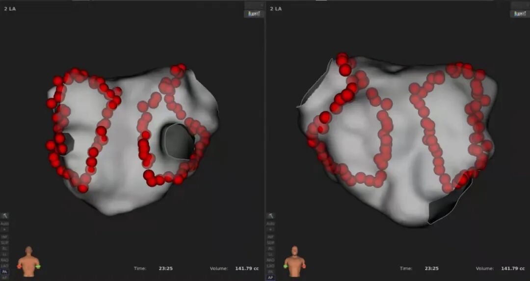 手术消融电极怎么用广州医科大学附属第二医院成功应用DIRECTSENSE™局部阻抗监测技术完成房颤射频消融手术_https://www.jmylbn.com_新闻资讯_第3张