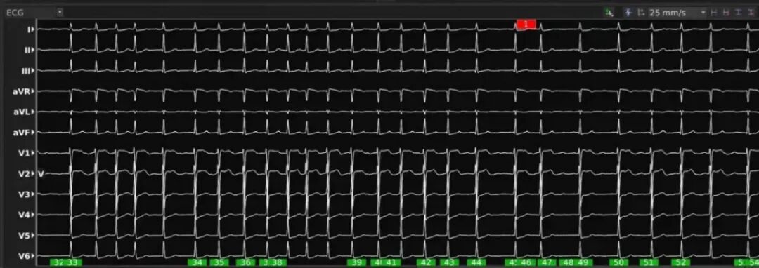 手术消融电极怎么用广州医科大学附属第二医院成功应用DIRECTSENSE™局部阻抗监测技术完成房颤射频消融手术_https://www.jmylbn.com_新闻资讯_第2张