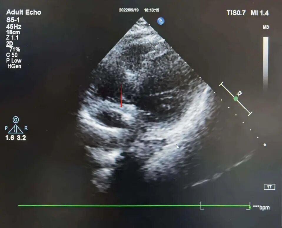 手术电极是什么意思超声引导，东莞市人民医院心内科团队“零射线”植入心系列双腔起搏器_https://www.jmylbn.com_新闻资讯_第5张