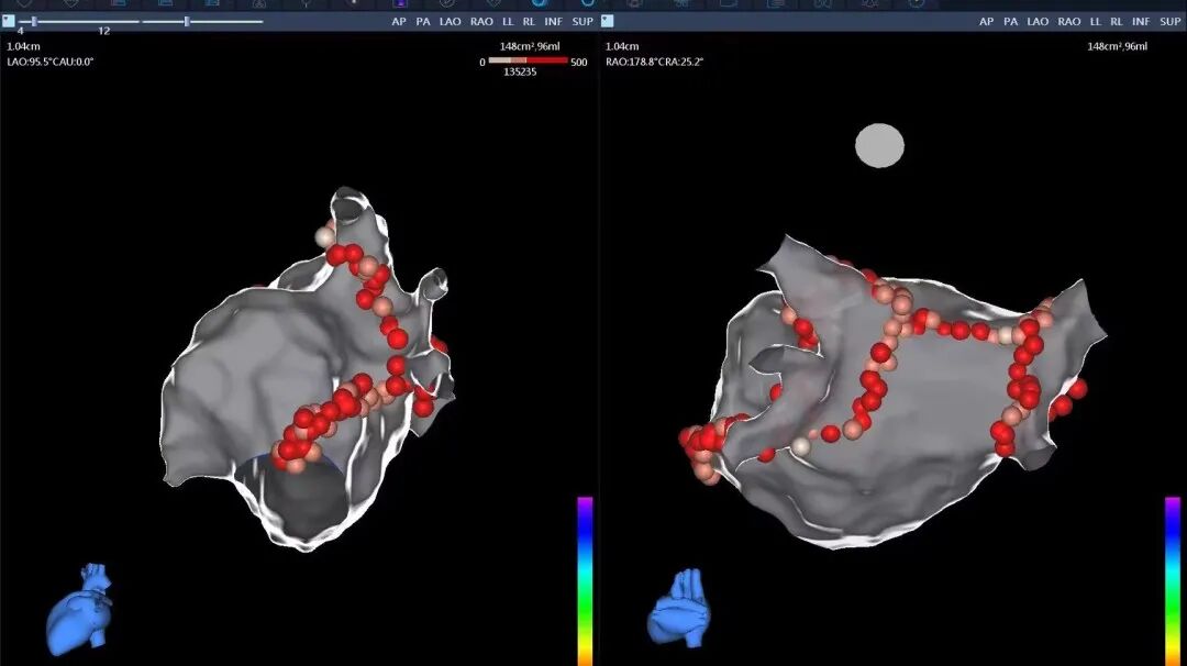 电生理器械怎么销售TrueForce®压力导管上市后首战告捷：从微创电生理看国产创新医疗器械的“突围”_https://www.jmylbn.com_新闻资讯_第7张