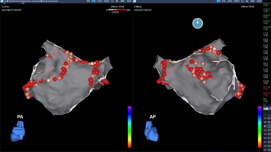 电生理器械怎么销售TrueForce®压力导管上市后首战告捷：从微创电生理看国产创新医疗器械的“突围”_https://www.jmylbn.com_新闻资讯_第6张