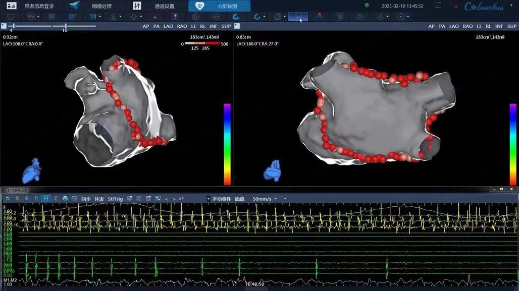电生理器械怎么销售TrueForce®压力导管上市后首战告捷：从微创电生理看国产创新医疗器械的“突围”_https://www.jmylbn.com_新闻资讯_第5张