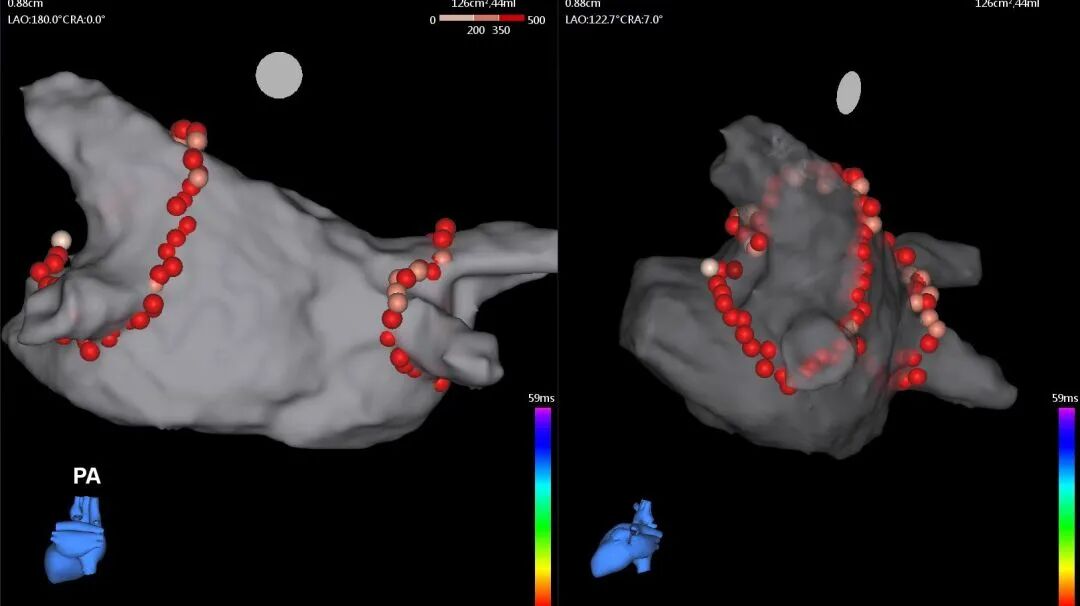 电生理器械怎么销售TrueForce®压力导管上市后首战告捷：从微创电生理看国产创新医疗器械的“突围”_https://www.jmylbn.com_新闻资讯_第4张