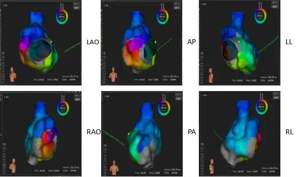 手术消融电极怎么用梅州市人民医院（黄塘医院）成功应用Rhythmia三维标测系统及DIRECTSENSE™技术完成外科术后房扑射频消融手术_https://www.jmylbn.com_新闻资讯_第5张