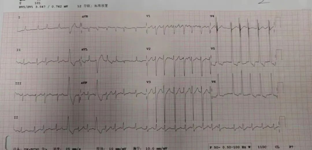 消融电极医院怎么收费节律重整 收获心生｜北京大学第一医院心内科团队率先使用左室主动电极行房室结消融+LOT-CRT一站式手术_https://www.jmylbn.com_新闻资讯_第1张