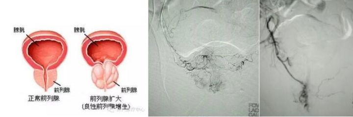 前列腺增生栓塞—在局部麻醉下,通過向前列腺供血動脈內注射栓塞微球